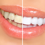 teeth whitening Budapest Hungary SwissMedFlight