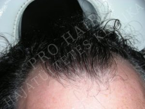 Before After Pictures FUE Hair Transplant in Budapest, Hungary