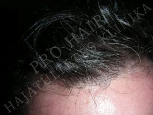 Before After Pictures FUE Hair Transplant in Budapest, Hungary