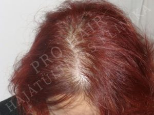 greffe de cheveux FUE et implants capillaires Budapest Hongrie avec SwissMedFlight