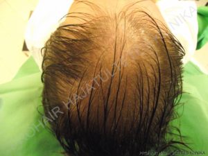 Before After Pictures FUE Hair Transplant in Budapest, Hungary