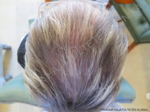 greffe de cheveux FUE et implants capillaires Budapest Hongrie avec SwissMedFlight