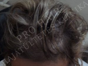 greffe de cheveux FUE et implants capillaires Budapest Hongrie avec SwissMedFlight