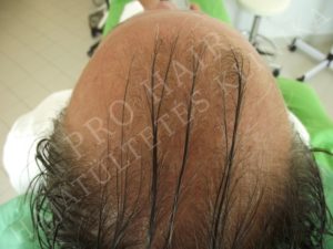 greffe de cheveux FUE et implants capillaires Budapest Hongrie avec SwissMedFlight