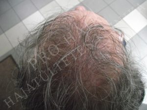 Before After Pictures FUE Hair Transplant in Budapest, Hungary