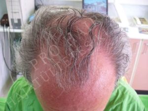 greffe de cheveux FUE et implants capillaires Budapest Hongrie avec SwissMedFlight