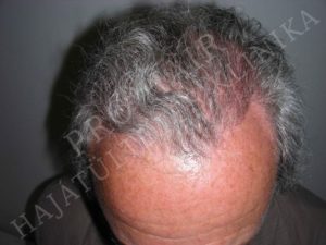 Before After Pictures FUE Hair Transplant in Budapest, Hungary