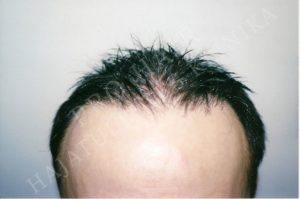 Before After Pictures FUE Hair Transplant in Budapest, Hungary