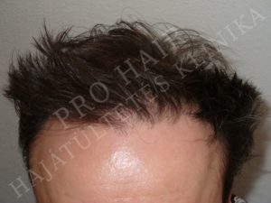 greffe de cheveux FUE et implants capillaires Budapest Hongrie avec SwissMedFlight