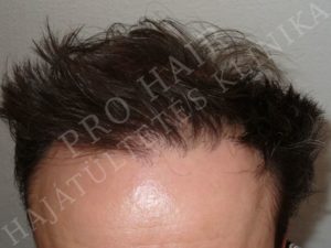 Before After Pictures FUE Hair Transplant in Budapest, Hungary