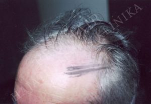 greffe de cheveux FUE et implants capillaires Budapest Hongrie avec SwissMedFlight