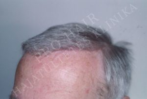 Before After Pictures FUE Hair Transplant in Budapest, Hungary
