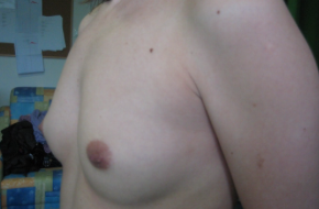 augmentation mammaire par implant mammaire Mentor Sebbin Budapest Hongrie SwissMedFlight Chirurgie esthétique Budapest Hongrie