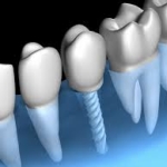 Dental implants abroad - Budapest Hungary - SwissMedFlight