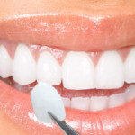 dental veneers