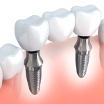 bridge sur implant dentaire - Budapest Hongrie