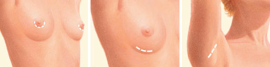 incisions - breast implant - Budapest Hungary