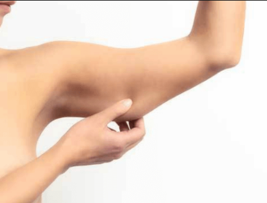 arm liposuction - SwissMedFlight